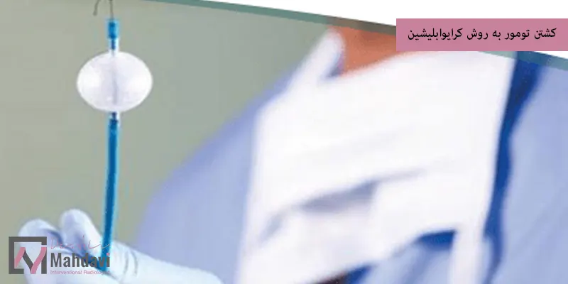 کشتن تومور به روش کرایوابلیشین