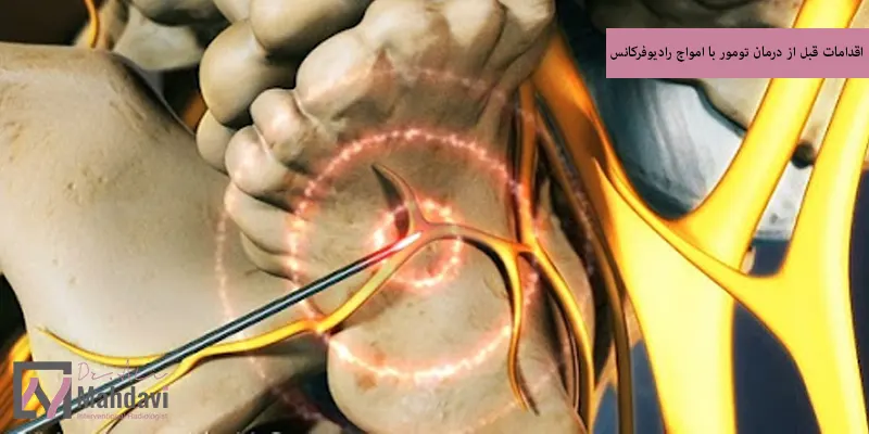 اقدامات قبل از درمان تومور با امواج رادیوفرکانس