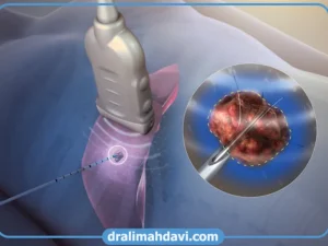 درمان تومور با امواج رادیوفرکانس به چه صورت است