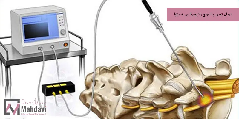 درمان تومور با امواج رادیوفرکانس + مزایا