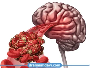 ترومبولیز چیست؟