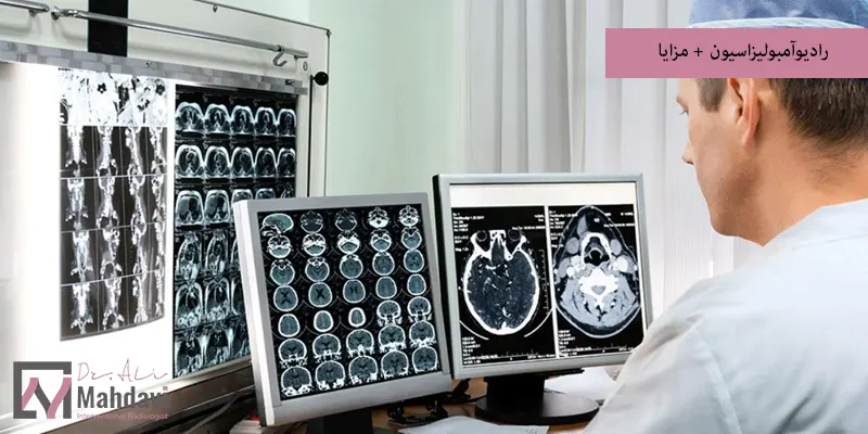 رادیوآمبولیزاسیون + مزایا