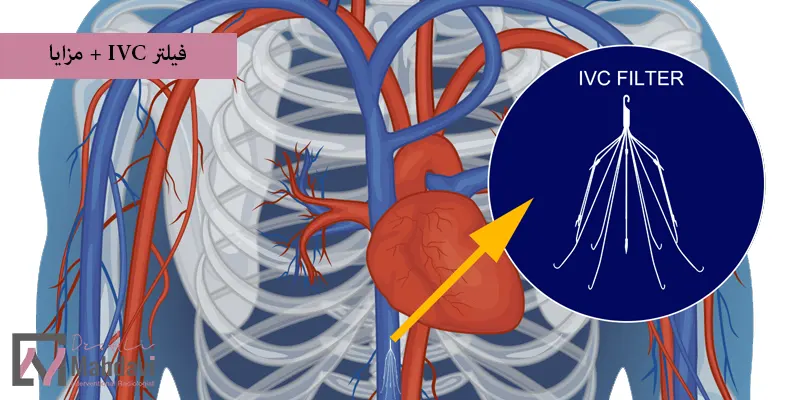 فیلتر IVC + مزایا