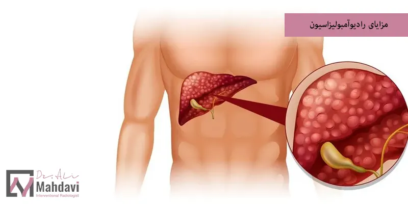 مزایای رادیوآمبولیزاسیون