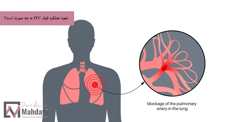 نحوه عملکرد فیلتر IVC به چه صورت است؟