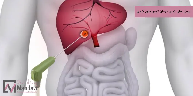 روش های نوین درمان تومورهای کبدی