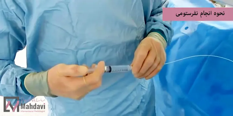 نحوه انجام نفرستومی