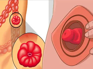 کله سیستوستومی