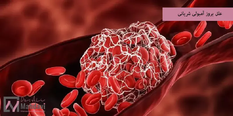 علل بروز آمبولی شریانی