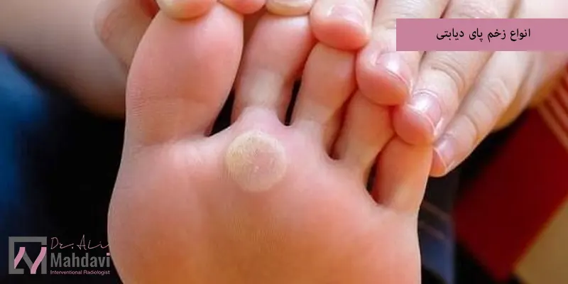 انواع زخم پای دیابتی