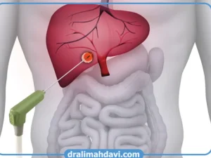 درمان متاستاز کبدی