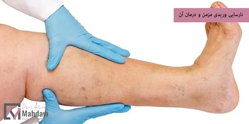 نارسایی وریدی مزمن و درمان آن