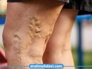 واریس و سندروم احتقان لگنی