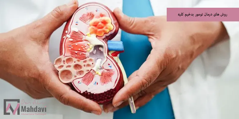 روش های درمان تومور بدخیم کلیه