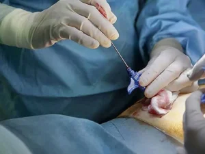 بیوپسی پروستات