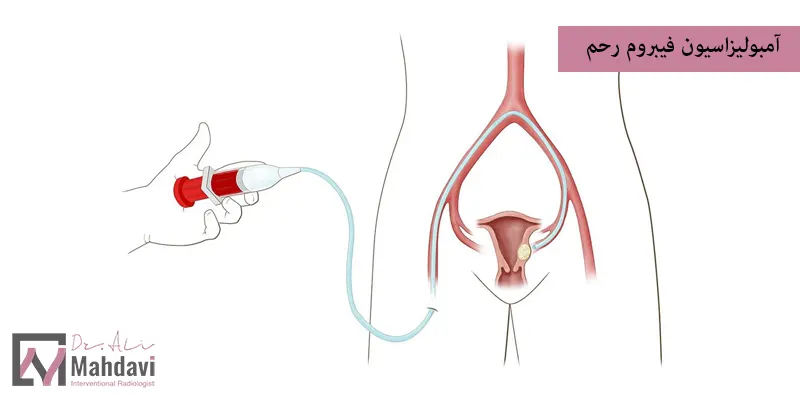 آمبولیزاسیون فیبروم رحم