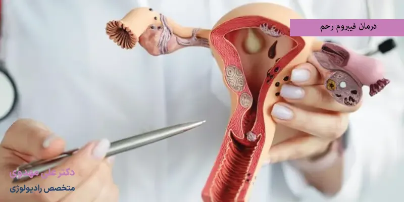 درمان فیبروم رحم