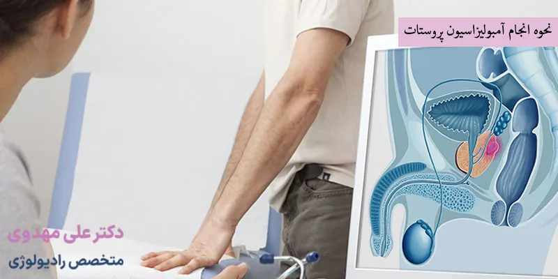 نحوه انجام آمبولیزاسیون پروستات