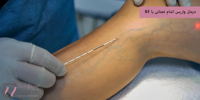 درمان واریس اندام تحتانی با RF