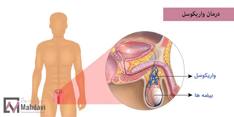 درمان واریکوسل