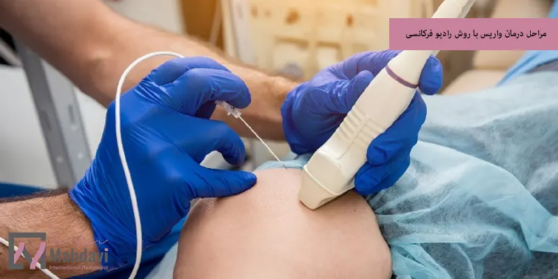 مراحل درمان واریس با روش رادیو فرکانسی