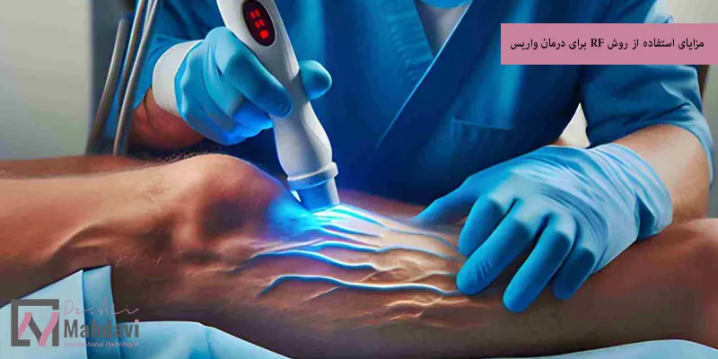 مزایای استفاده از روش RF برای درمان واریس
