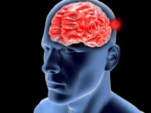 آنوریسم مغزی