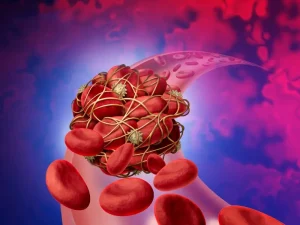 ترومبوآمبولی شریانی