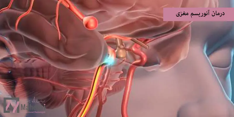 درمان آنوریسم مغزی