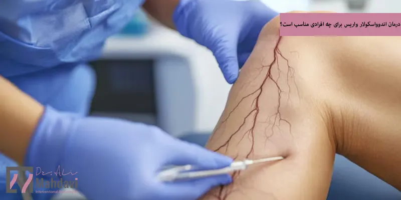 درمان اندوواسکولار واریس برای چه افرادی مناسب است؟