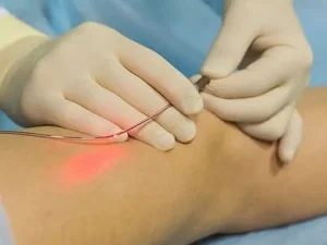 درمان واریس با اندوواسکولار