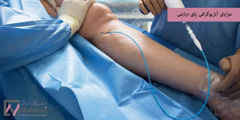 مزایای آنژیوگرافی پای دیابتی