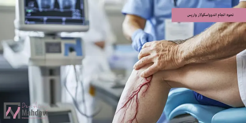 نحوه انجام اندوواسکولار واریس