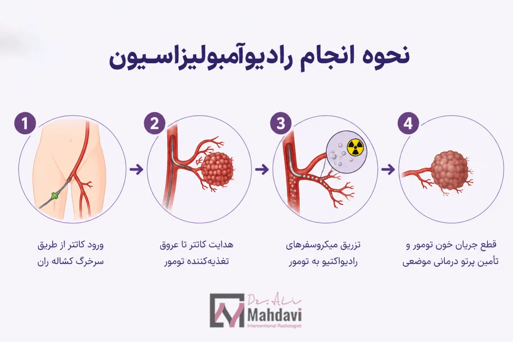 نحوه انجام رادیوآمبولیزاسیون
