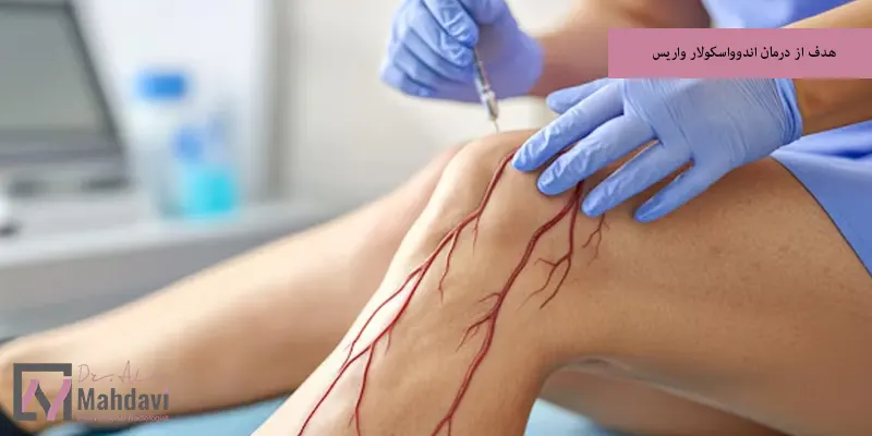 هدف از درمان اندوواسکولار واریس