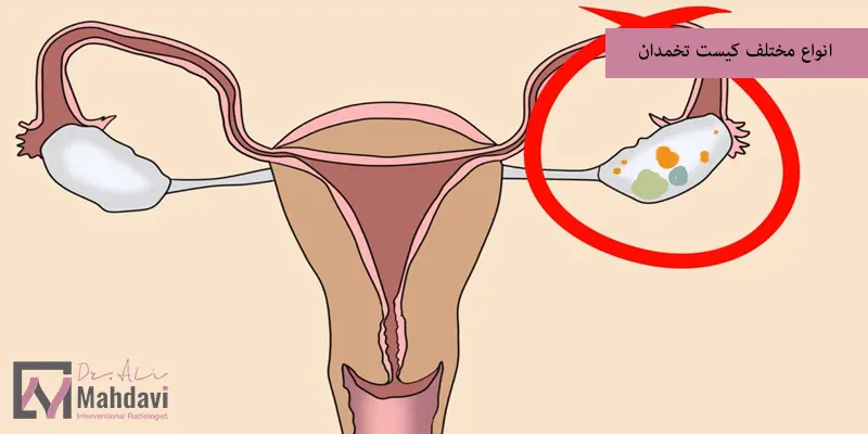 انواع مختلف کیست تخمدان