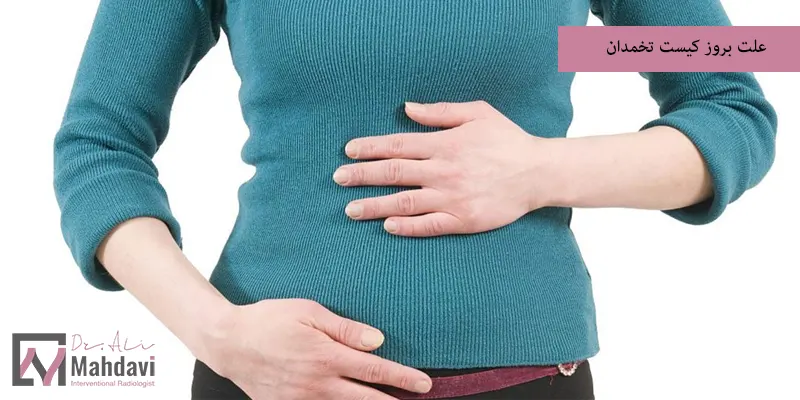 علت بروز كيست تخمدان