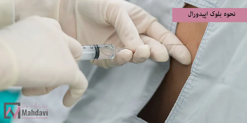 نحوه بلوک اپیدورال