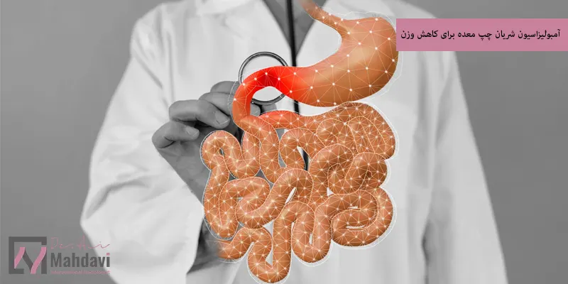 آمبولیزاسیون شریان چپ معده برای کاهش وزن