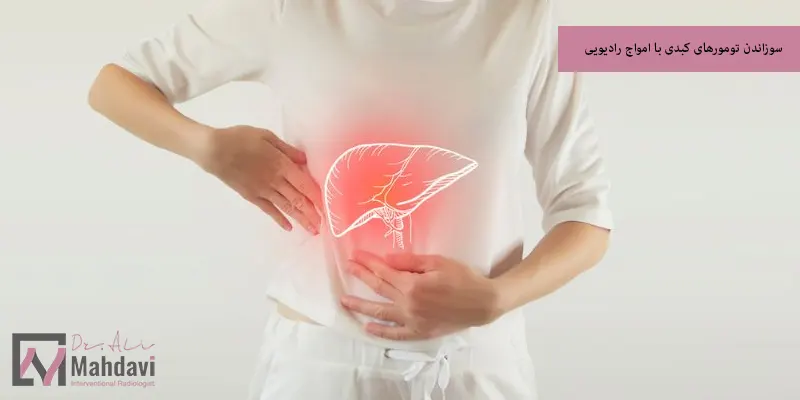 سوزاندن تومورهای کبدی با امواج رادیویی