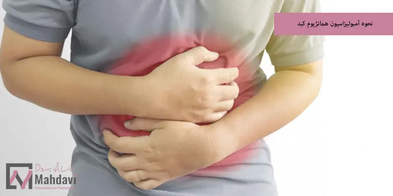 نحوه آمبولیزاسیون همانژیوم کبد