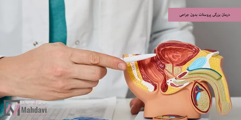 درمان بزرگی پروستات بدون جراحی