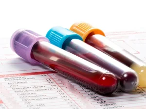 ازمایش PSA پروستات