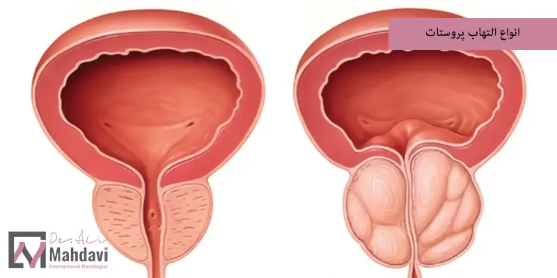 انواع التهاب پروستات