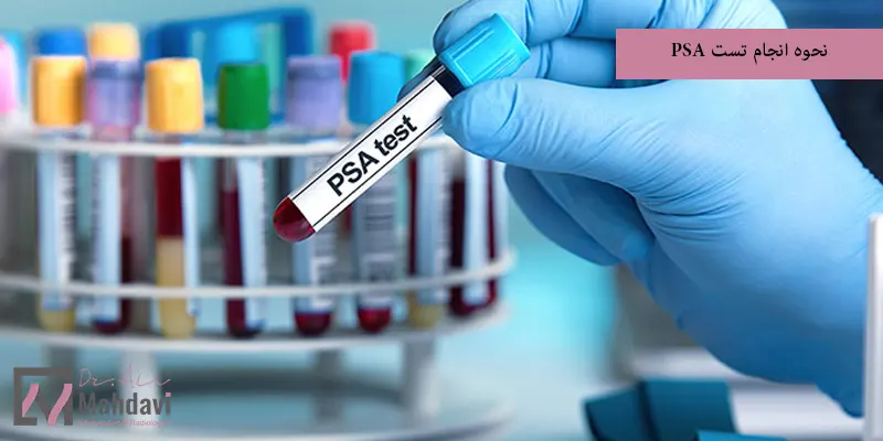 نحوه انجام تست PSA