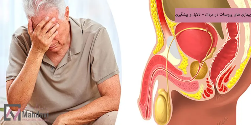 بیماری های پروستات در مردان + دلایل و پیشگیری