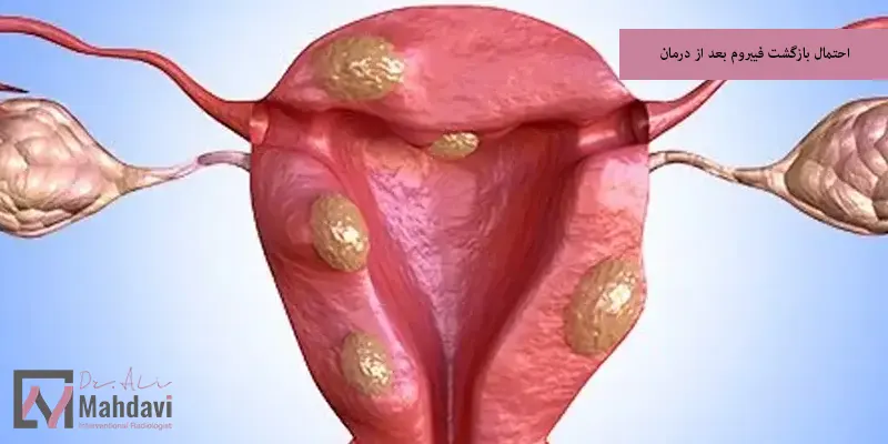 احتمال بازگشت فیبروم بعد از درمان