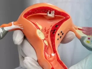 بازگشت فیبروم رحم بعدا ز درمان