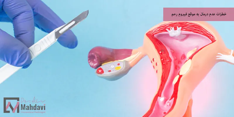 خطرات عدم درمان به موقع فیبروم رحم