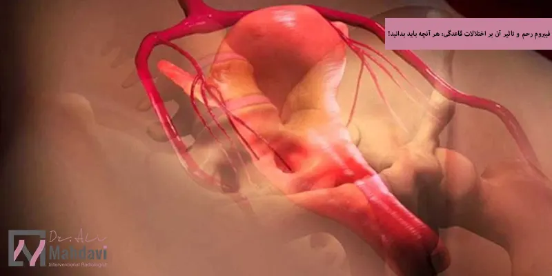 فیبروم رحم و تاثیر آن بر اختلالات قاعدگی هر آنچه باید بدانید!